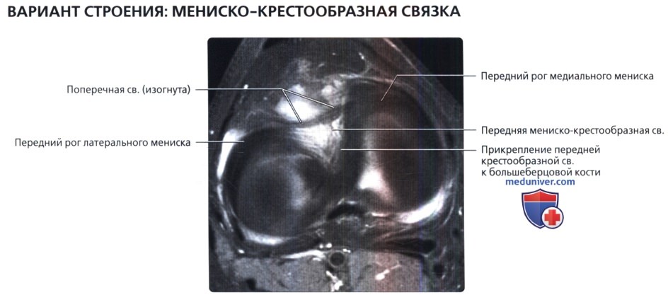 Варианты нормы менисков коленного сустава на МРТ