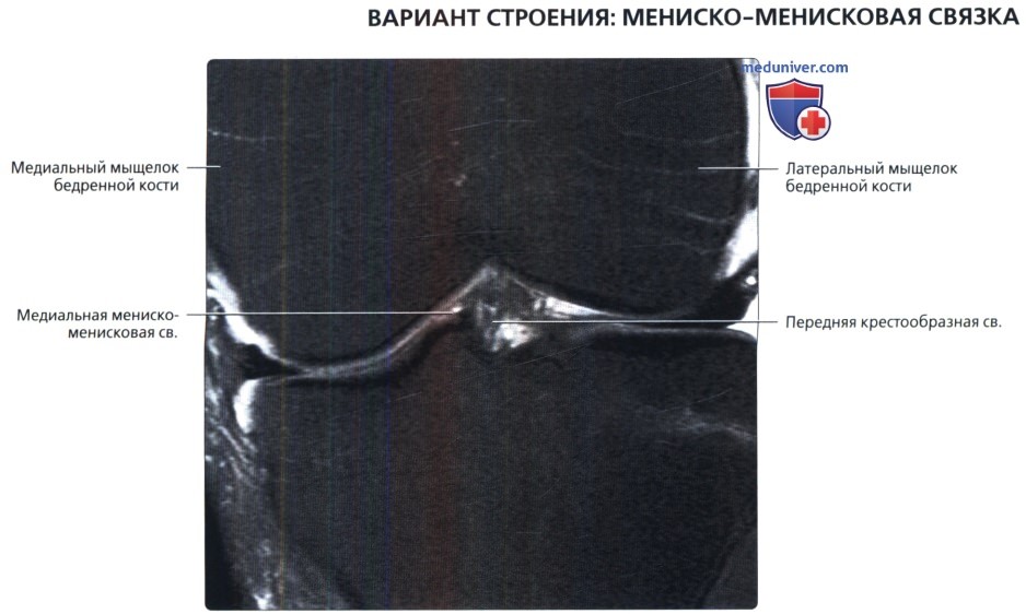 Варианты нормы менисков коленного сустава на МРТ