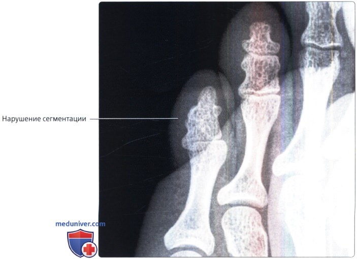 Варианты строения пальцев стопы на рентгенограмме
