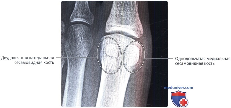 Варианты строения сесамовидных костей стопы на рентгенограмме, МРТ