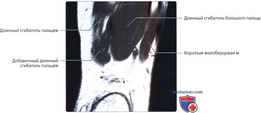 Варианты строения мышц сгибателей пальцев стопы на МРТ