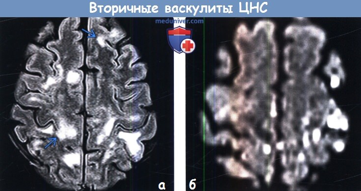 Вторичные васкулиты (васкулопатии, ангииты) головного мозга на МРТ
