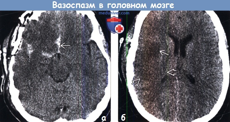 Церебральный вазоспазм при эндоваскулярных вмешательствах на сосудах головного мозга