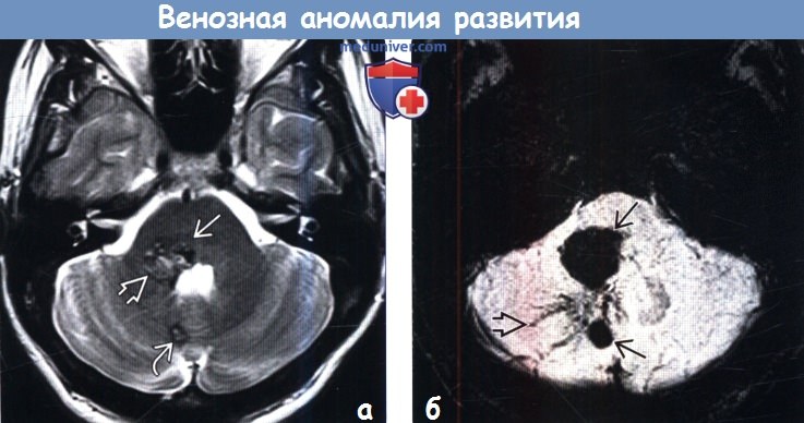 Венозная аномалия развития головного мозга на МРТ