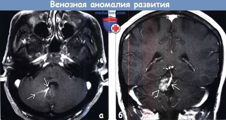 Кавернома головного мозга