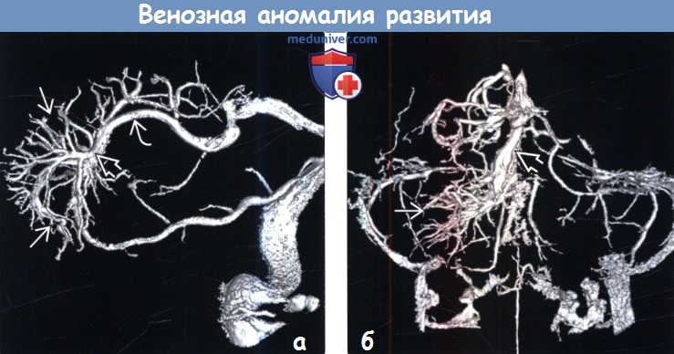 Венозная аномалия развития головного мозга на ангиограмме
