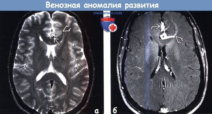 Венозная аномалия развития головного мозга на МРТ