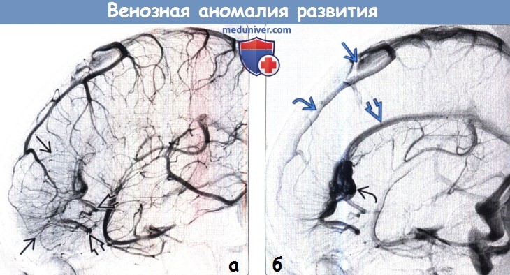 Венозная аномалия развития головного мозга на ангиограмме