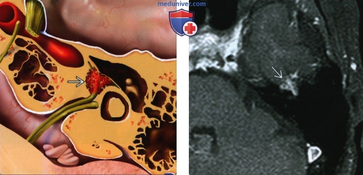 Венозная мальформация лицевого нерва (ВМЛН) в височной кости - лучевая диагностика