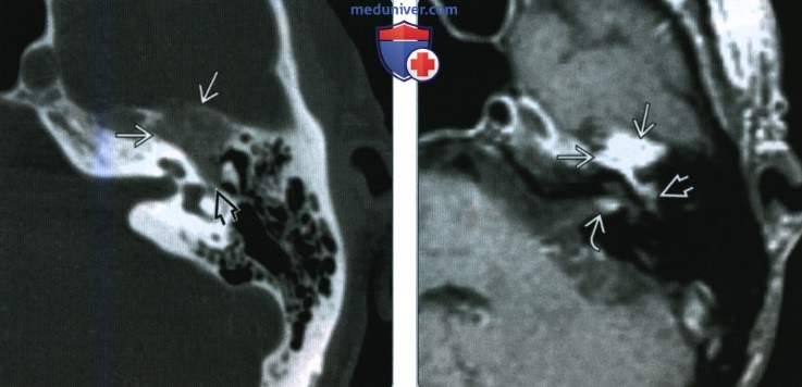 Венозная мальформация лицевого нерва (ВМЛН) в височной кости - лучевая диагностика