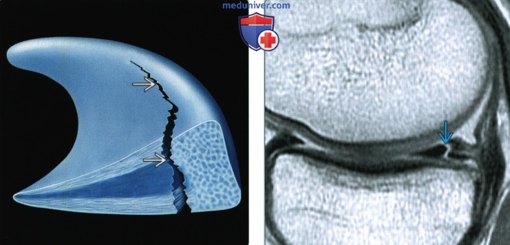 Признаки вертикального продольного разрыва мениска коленного сустава