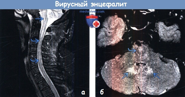 Вирусный энцефалит на МРТ