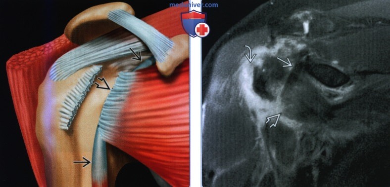 Признаки вывиха сухожилия двуглавой мышцы плеча