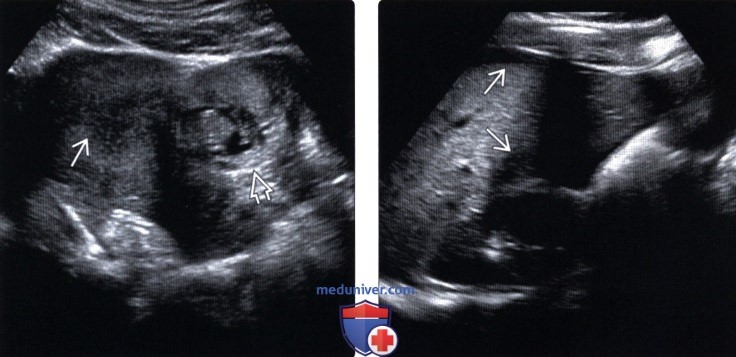 Методы обследования редких форм эктопической беременности