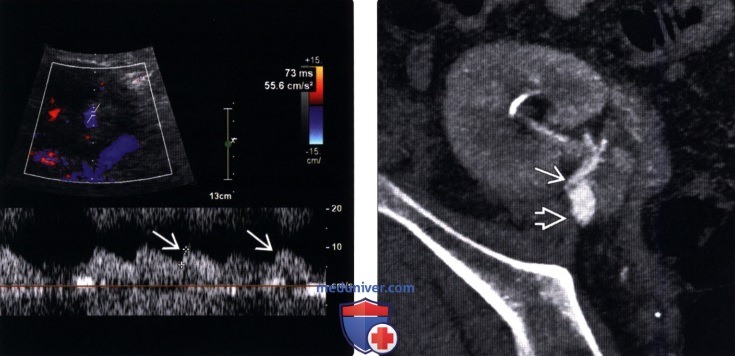 Методы обследования стеноза почечной артерии трансплантата почки