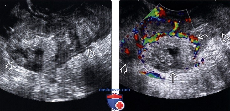 Методы обследования трубной внематочной беременности
