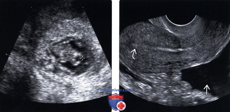 Методы обследования трубной внематочной беременности