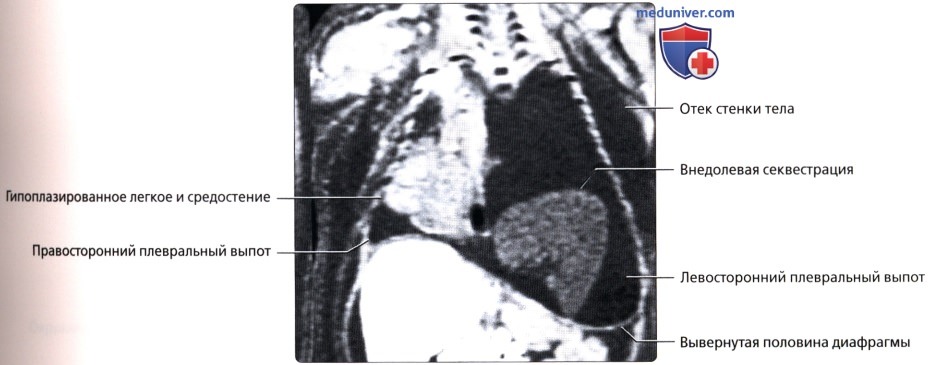 МРТ при внедолевой секвестрации у новорожденного