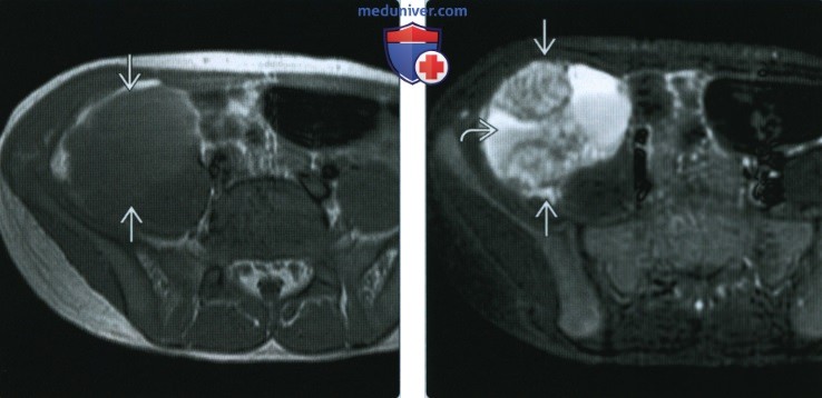 Внескелетная опухоль Юинга - лучевая диагностика
