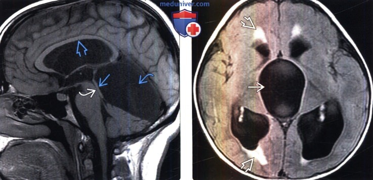 vnutrenneiaia obstruktivnaia gidrocefalia 3