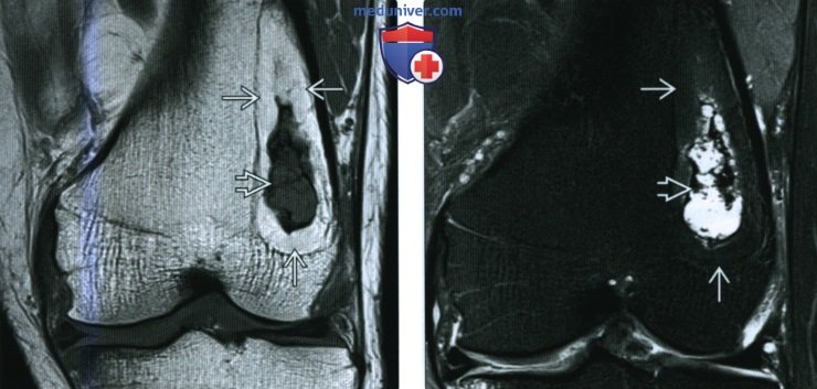 Рентгенограмма, КТ, МРТ при внутрикостной липоме
