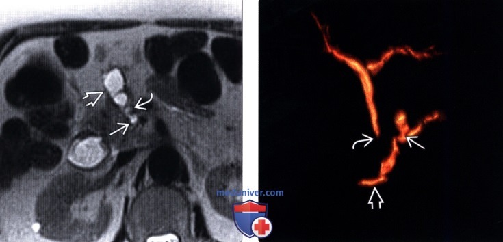 УЗИ, МР холангиопанкреатография при внутрипротоковой папиллярной муцинозной опухоли поджелудочной железы