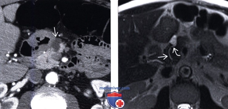 КТ, МРТ при внутрипротоковой папиллярной муцинозной опухоли поджелудочной железы