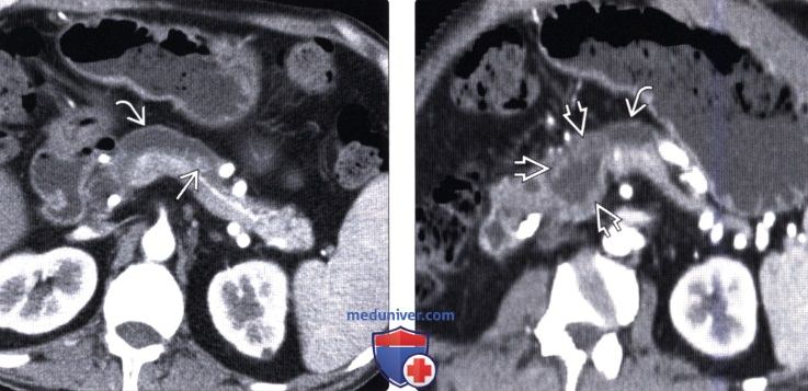 КТ при внутрипротоковой папиллярной муцинозной опухоли поджелудочной железы