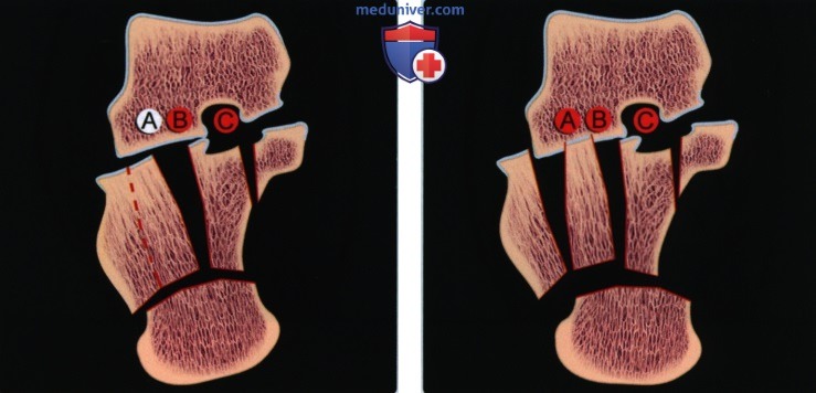 Признаки внутрисуставного перелома пяточной кости