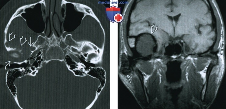 Пигментный ворсинчато-узелковый синовит височно-нижнечелюстного сустава (ВНЧС) - лучевая диагностика