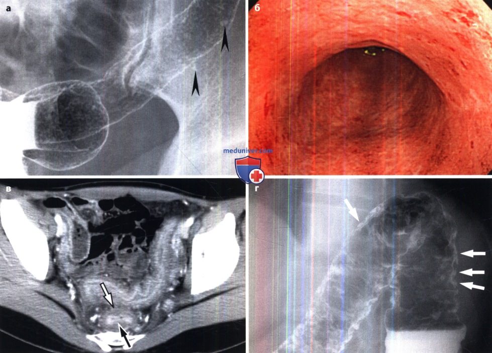 Рентген кишечника при язвенном колите thumbnail
