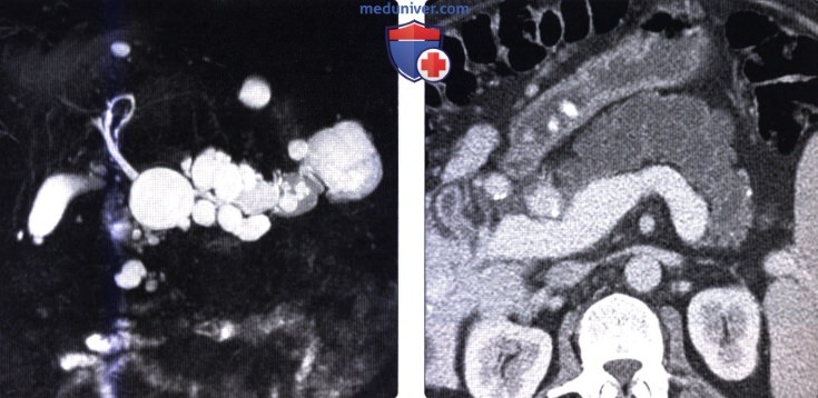 Методы обследования внутрипротоковой папиллярно-муцинозной опухоли (ВПМО) поджелудочной железы