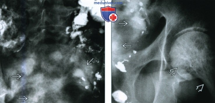 Вторичная остеосаркома - лучевая диагностика