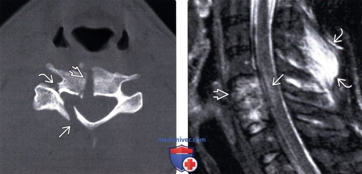 КТ, МРТ взрывного перелома шейного позвонка