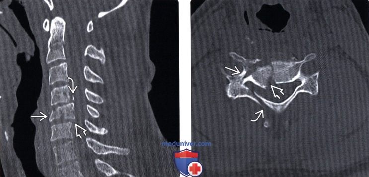 Переломы шейного отдела позвоночника рентген thumbnail