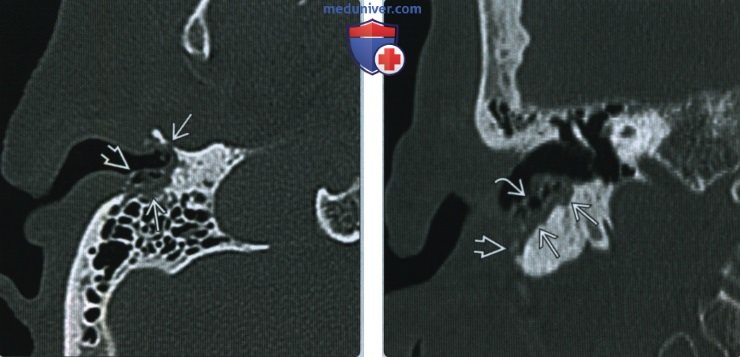 Приобретенная холестеатома наружного слухового канала (НСК) - лучевая диагностика