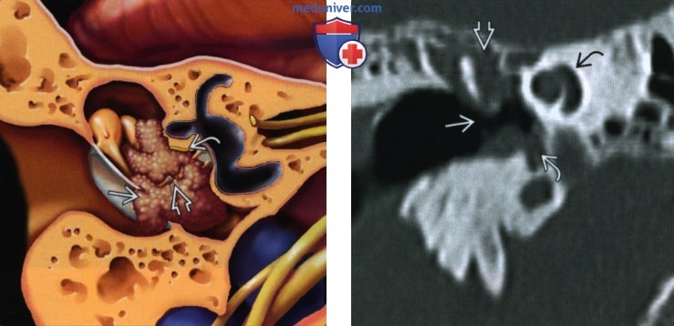 Холестеатома натянутой части барабанной перегородки - лучевая диагностика