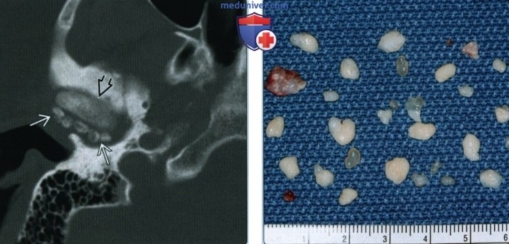 Синовиальный хондроматоз височно-нижнечелюстного сустава (ВНЧС) - лучевая диагностика