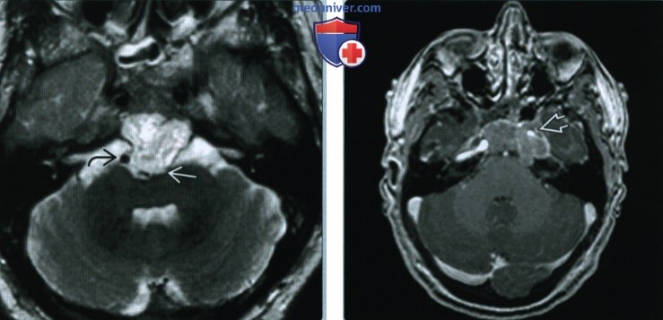 Хордома затылочной кости (основания черепа) - лучевая диагностика