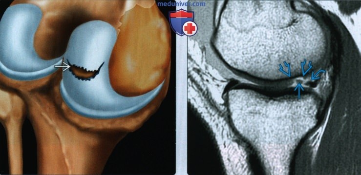 Признаки хрящевой травмы колена