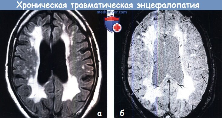 Хтэ это. Хроническая травматическая энцефалопатия снимок. Застарелый травматический генез. Хронической травматической энцефалопатии — дегенерацией мозга.