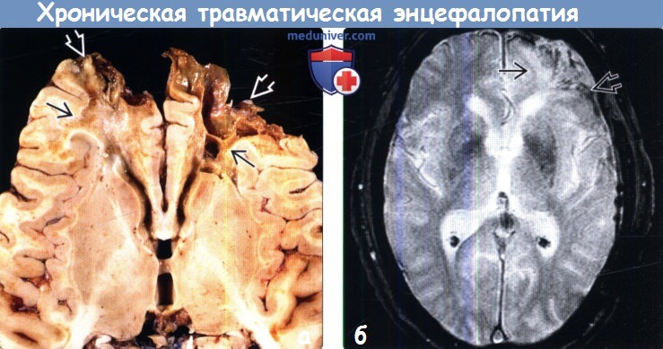 Хтэ это. Посттравматическая энцефалопатия головного мозга на мрт. Дисциркуляторная энцефалопатия мрт. Энцефалопатия на кт мозга. Энцефалопатия головного мозга на мрт.