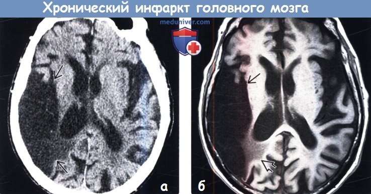 Хронический инфаркт головного мозга на КТ, МРТ