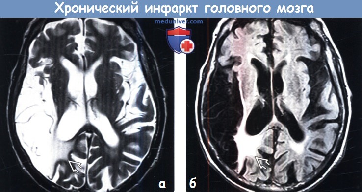 Хронический инфаркт головного мозга на МРТ