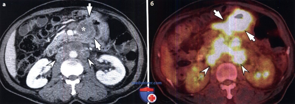 Рентгенограмма, КТ при карциноиде тонкой кишки (нейроэндокринной опухоли)