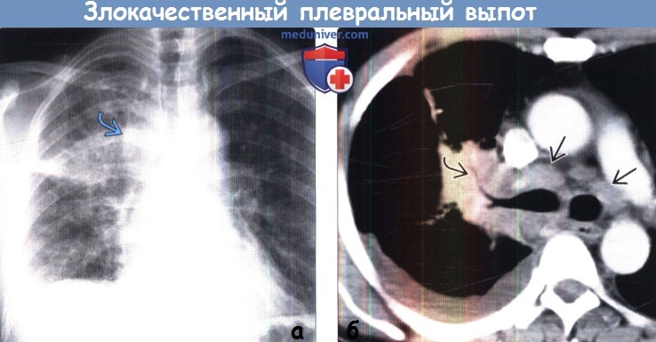 Злокачественный плевральный выпот на рентгенограмме, КТ