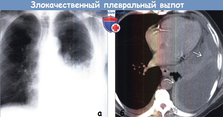 Злокачественный плевральный выпот на рентгенограмме, КТ