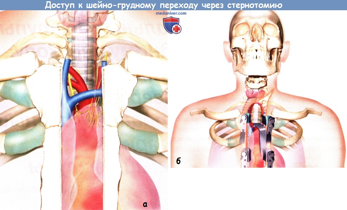 Доступ к шейно-грудному отделу позвоночника через стернотомию