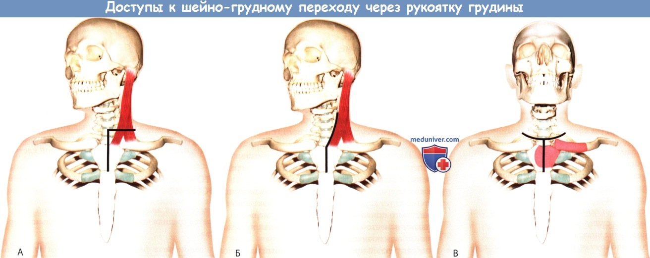 Доступ к шейно-грудному отделу позвоночника через рукоятку грудины