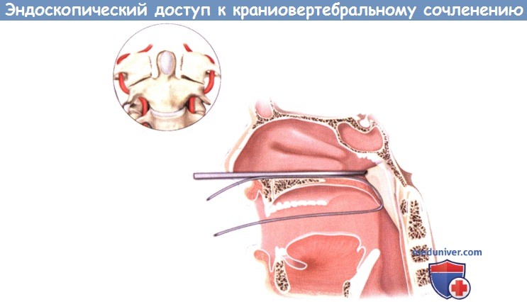 Эндоскопические осложнения. Декомпрессия краниовертебрального перехода. Эндоскопическая хирургическая анатомия. Эндоскопический доступ.